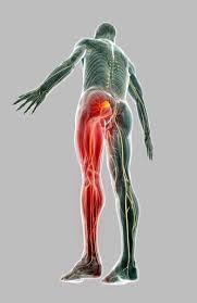 Sciatica Ernia del disco e sciatica