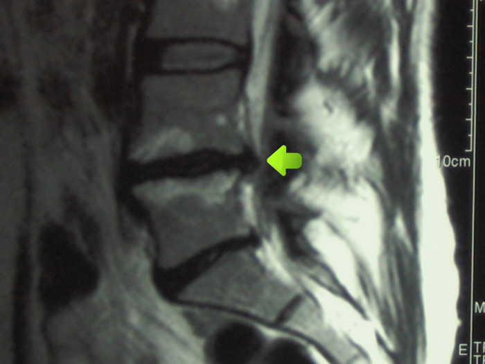 Herniated disc before treatment Herniated disc before treatment