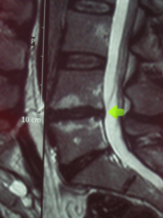 Herniated disc after treatment