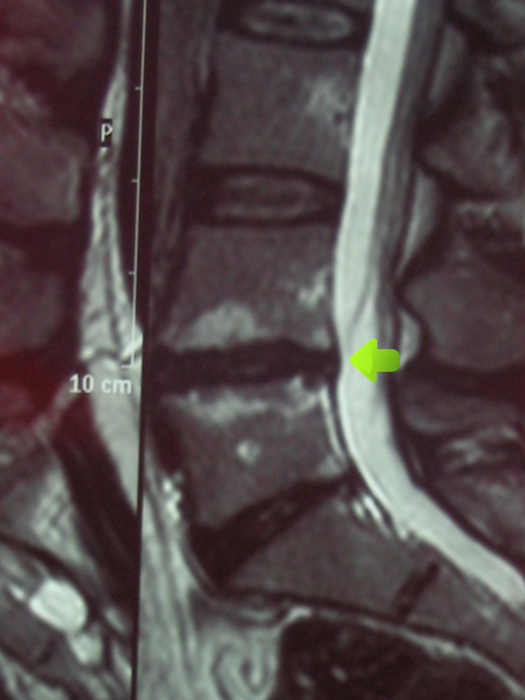 Herniated disc after treatment Herniated disc after treatment