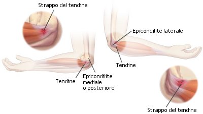 Epicondilite laterale e mediale