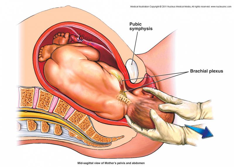brachial plexus delivery