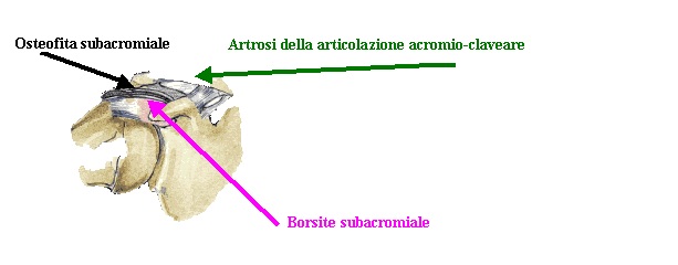 periartrite2